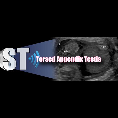Torsed Appendix Testis – Sonographic Tendencies