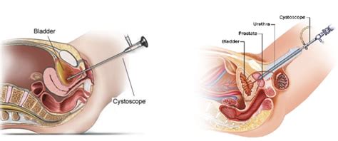 Image result for Retro Pyelogram Cystoscopy