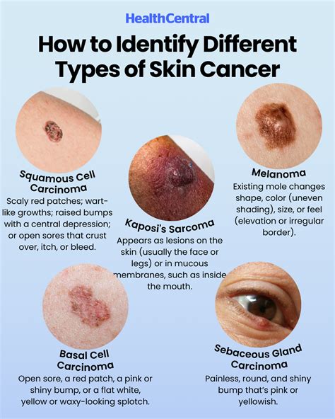 How to spot different types of skin cancer – Artofit