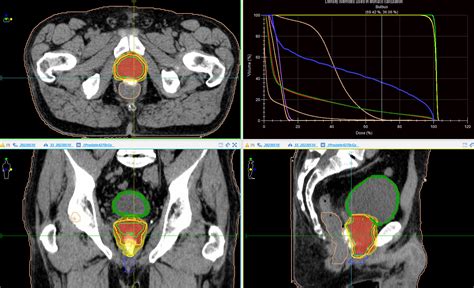 Prostate Radiation Simulation 的图像结果