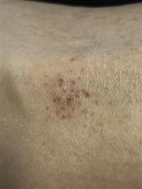 Itchy red spots on ankle : r/DermatologyQuestions