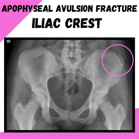 Avulsion Fracture Hip Iliac Crest