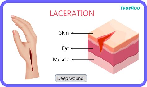 What Is A Hemostatic Laceration at Suzanne Hyatt blog