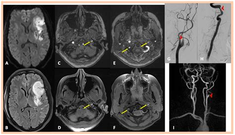Spontaneous Multiple Cervical Artery Dissections Detected with High ...