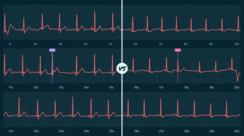 Premature Junctional Contraction (PJC) Vs. Premature Atrial Contraction ...