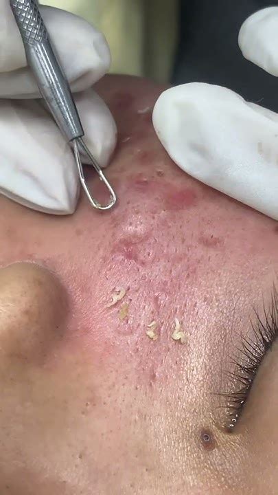 Image result for Carbuncle Extraction Doctor