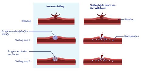 De ziekte van Von Willebrand - Patiëntenfolder - Erasmus MC