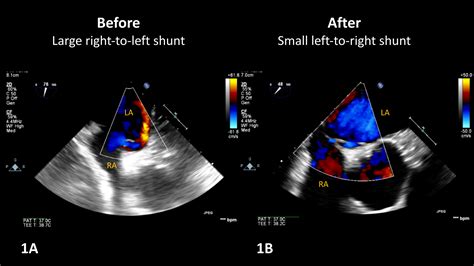 Intraoperative hypoxemia and dynamic right-to-left shunting across a patent foramen ovale ...