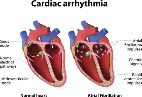 AFib Heart Condition 的图像结果