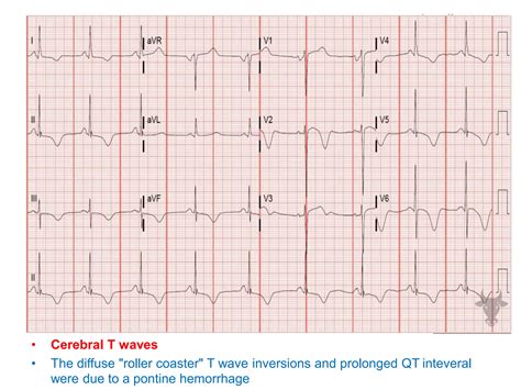 T WAVE IN ECG AND ITS ABNORMALITIES IN ECG | PPTX