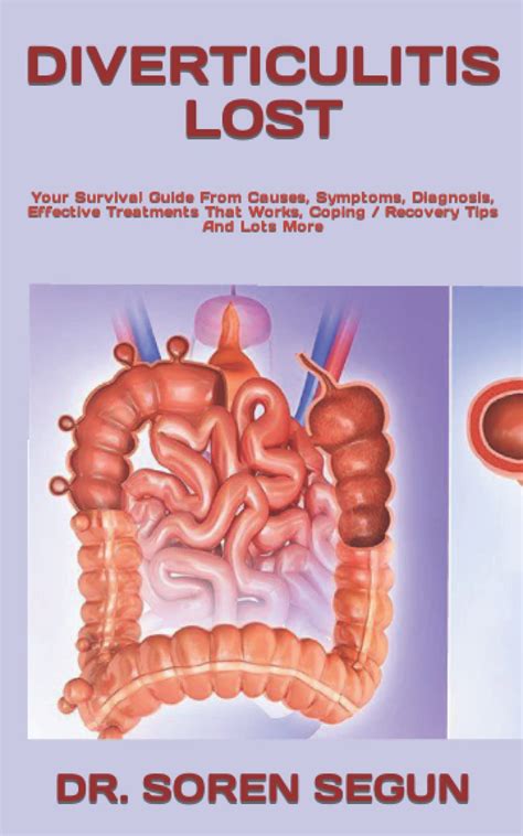 Buy DIVERTICULITIS LOST: Your Survival Guide From Causes, Symptoms ...