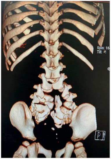Split Notochord Syndrome with Spinal Column Duplication and Spinal Cord ...