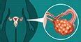 Ovarian Cancer Types and Stages