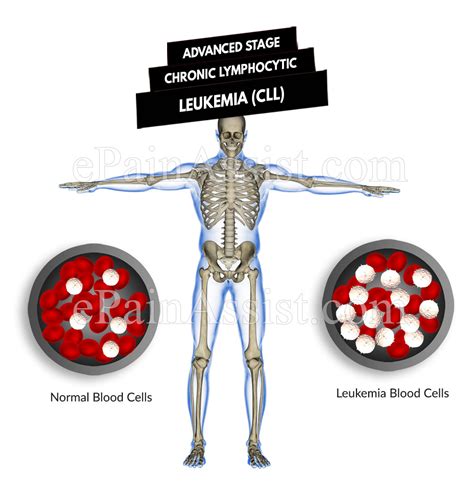Advanced Stage Chronic Lymphocytic Leukemia (CLL) | Symptoms & Treatment