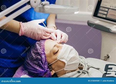 Patient Getting Laser Mole Removal. Skin Moles Treatment Stock Image - Image of liver, male ...