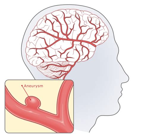 Common Brain Disorders and Brain Aneurysms: Early Warning Signs and ...