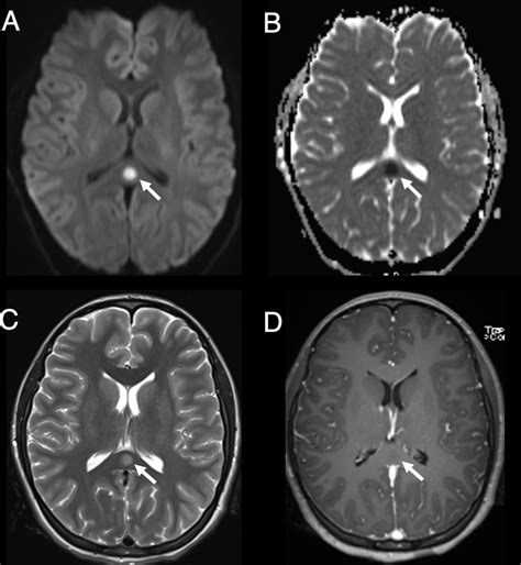 Neuroimaging features of psilocybin-induced toxic-metabolic encephalopathy in an adolescent ...