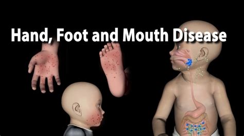 Causes of Hand, Foot, Mouth Disease (with CNS complications)