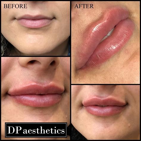 Lip Augmentation 0.5ml Filler Top Up - 1ml in total over 2 sittings Product - Juvederm Fully ...