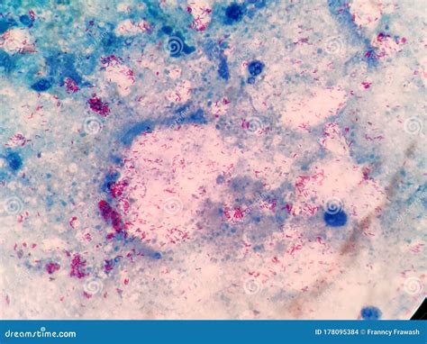 Acid-fast Bacilli. Ziehl Neelsen Stain Stock Photo | CartoonDealer.com ...