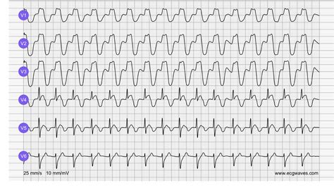 Ecg Test Strips Practice With Answers at Harry Pelfrey blog