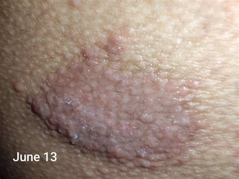 What is this? Buttock "rash" on right buttock : r/DermatologyQuestions