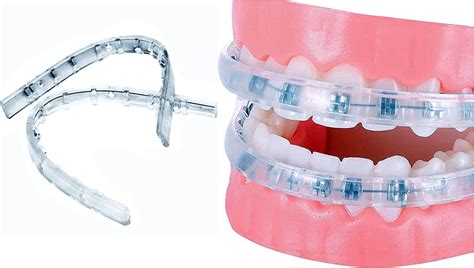 Buy Comfort Cover for Braces, Lip Protector Mouth Guard Lip Cushion ...