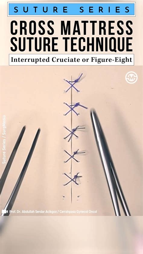 Image result for Simple Continuous Suture Removal