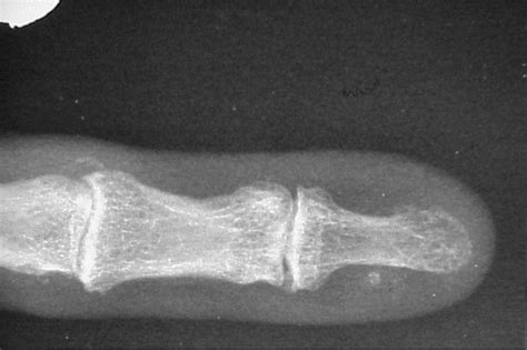 Image result for Transillumination