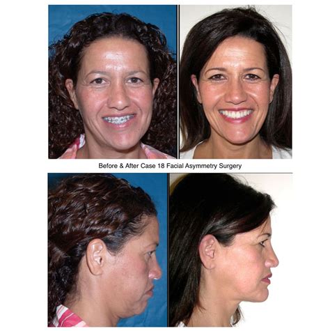 Asymmetrical Face Surgery