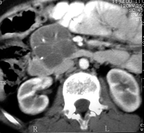 Pancreatic Cystosis in Children and Young Adults with Cystic Fibrosis ...