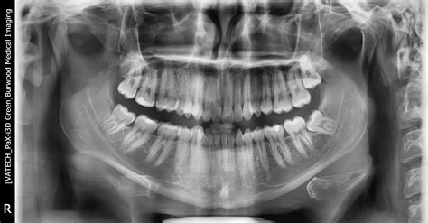 Partially erupted and impacted wisdom tooth, as well as a crooked teeth that are more caved in ...