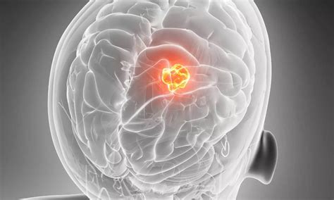 Stereotactic Radiation Improves Quality of Life in Patients With ...