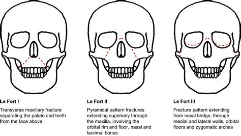 In-hospital management of the airway in trauma - BJA Education