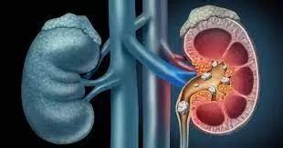 Acupuncture effective adjunctive therapy for relieving acute renal ...