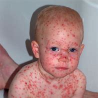 chickenpox 的图像结果