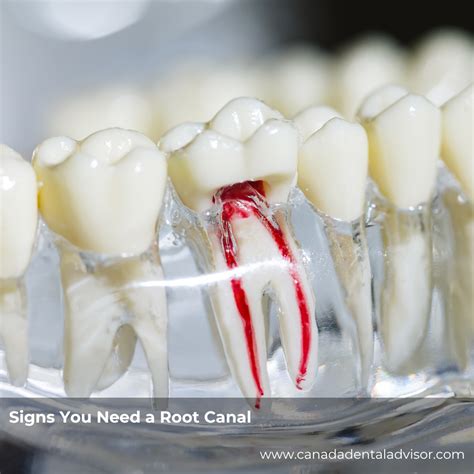 Signs You Need a Root Canal
