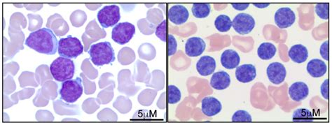 T-Cell Prolymphocytic Leukemia: Diagnosis, Pathogenesis, and Treatment