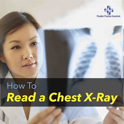 What Abbreviation Stands For Chest X-Ray at Sam Vanthoff blog