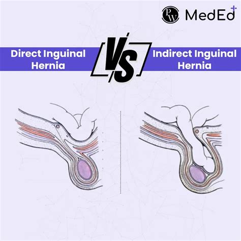 Direct And Indirect Inguinal Hernia