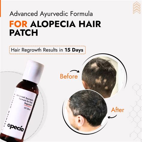 Alopecia Treatment in Chandigarh | Best Alopecia Doctor in Chandigarh ...