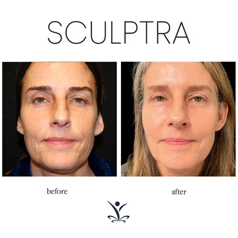 Before & After Sculptra | Sculptra, Sculptra aesthetic, Facial fillers