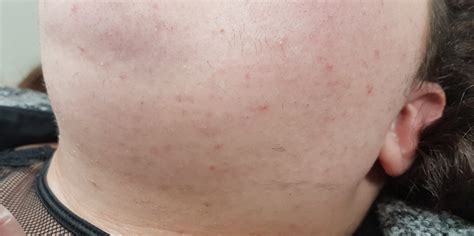 Polycystic Ovarian Syndrome PCOS hair removal uk London, Leeds Bury