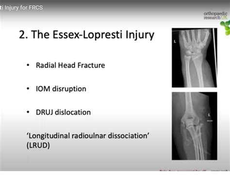 Essex Lopresti Fractures — OrthopaedicPrinciples.com