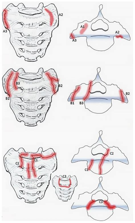 Sacroplasty for Sacral Insufficiency Fractures: Narrative Literature Review on Patient Selection ...