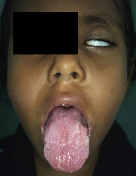 Melkersson Rosenthal Syndrome