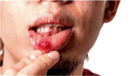 Mouth Ulcers Home Remedies: ঠোঁট-জিভের ঘায়ে কষ্ট পাচ্ছেন? ৩ অব্যর্থ ...