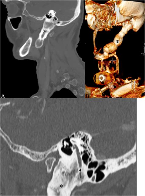 Osteochondroma of the temporal styloid process: a common disease in a ...