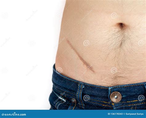 Closeup of Man Showing the Stomach with a Scar from Appendicitis ...