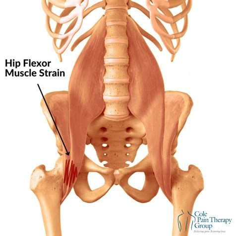 Understanding and Treating Hip Pain: A Complete Recovery Guide - Cole ...